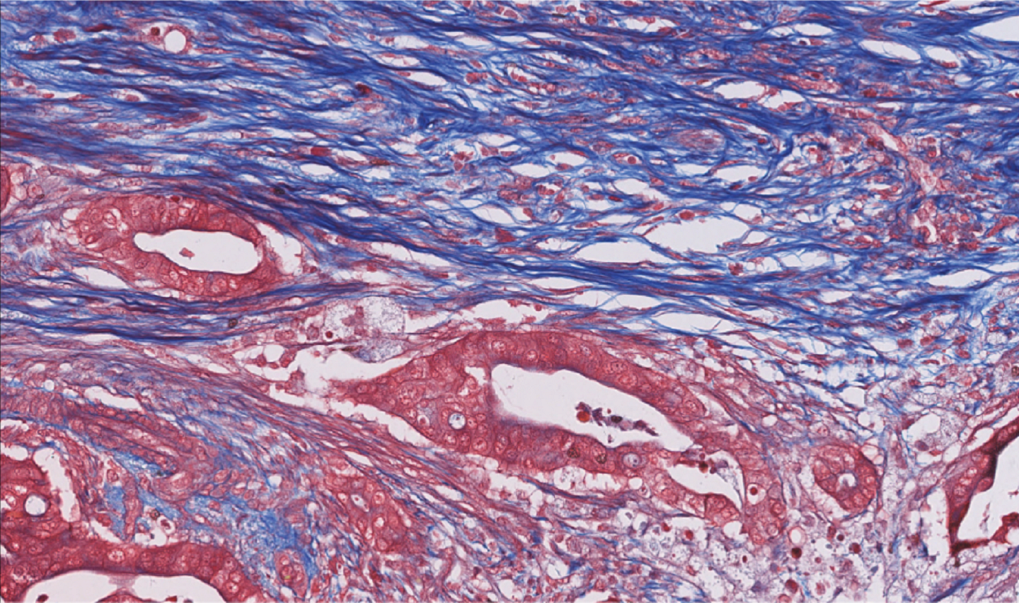 Microscopic image of pancreatic cancer cells